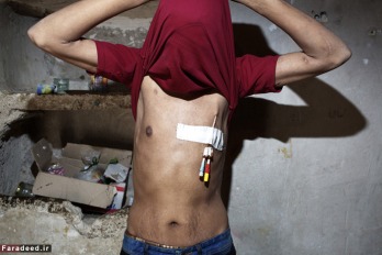 غفار نقدی، جوان بیست و چهار سالۀ ایرانی، روی تن خود زخم‌های شش سال نارسایی کلیوی را یدک می‌کشد. او مجبور است سه بار در هفته دیالیز کند. 